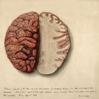 Mozak, ekstremni zagušenja, ilustracija, poster Ispis naučnog izvora